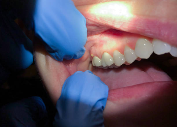 Best Emergency Wisdom Teeth Removal in Pacifi, CA
